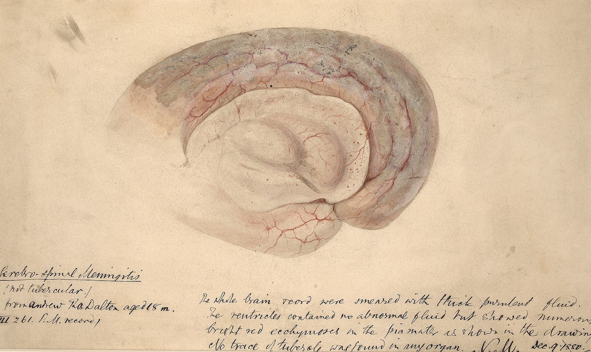 Imagem de referência de meningite, descrito nos dados abertos como inflamação das membranas ao redor do cérebro e da medula espinhal