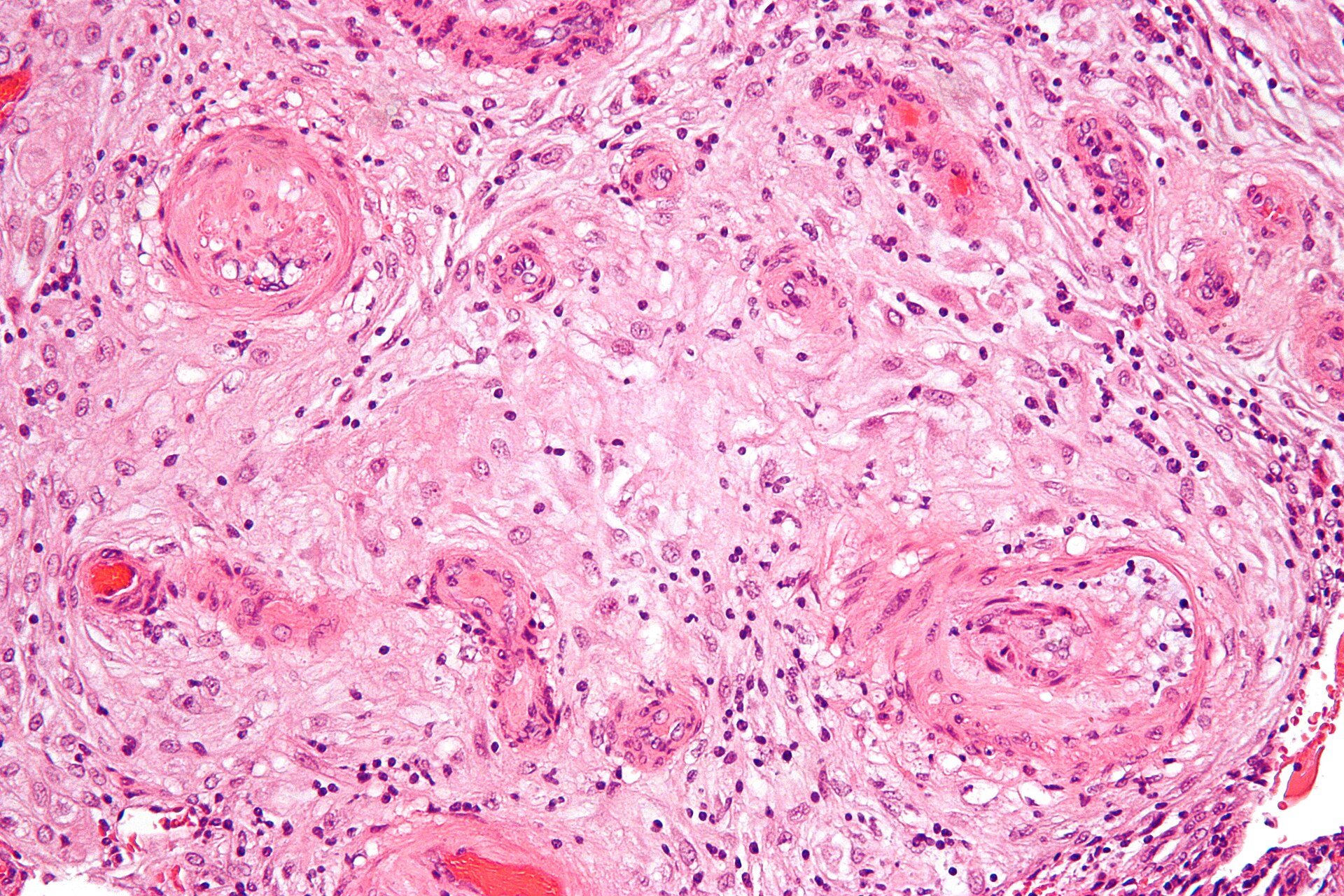 Imagem de referência de pré-eclampsia, descrito nos dados abertos como complicação da gravidez