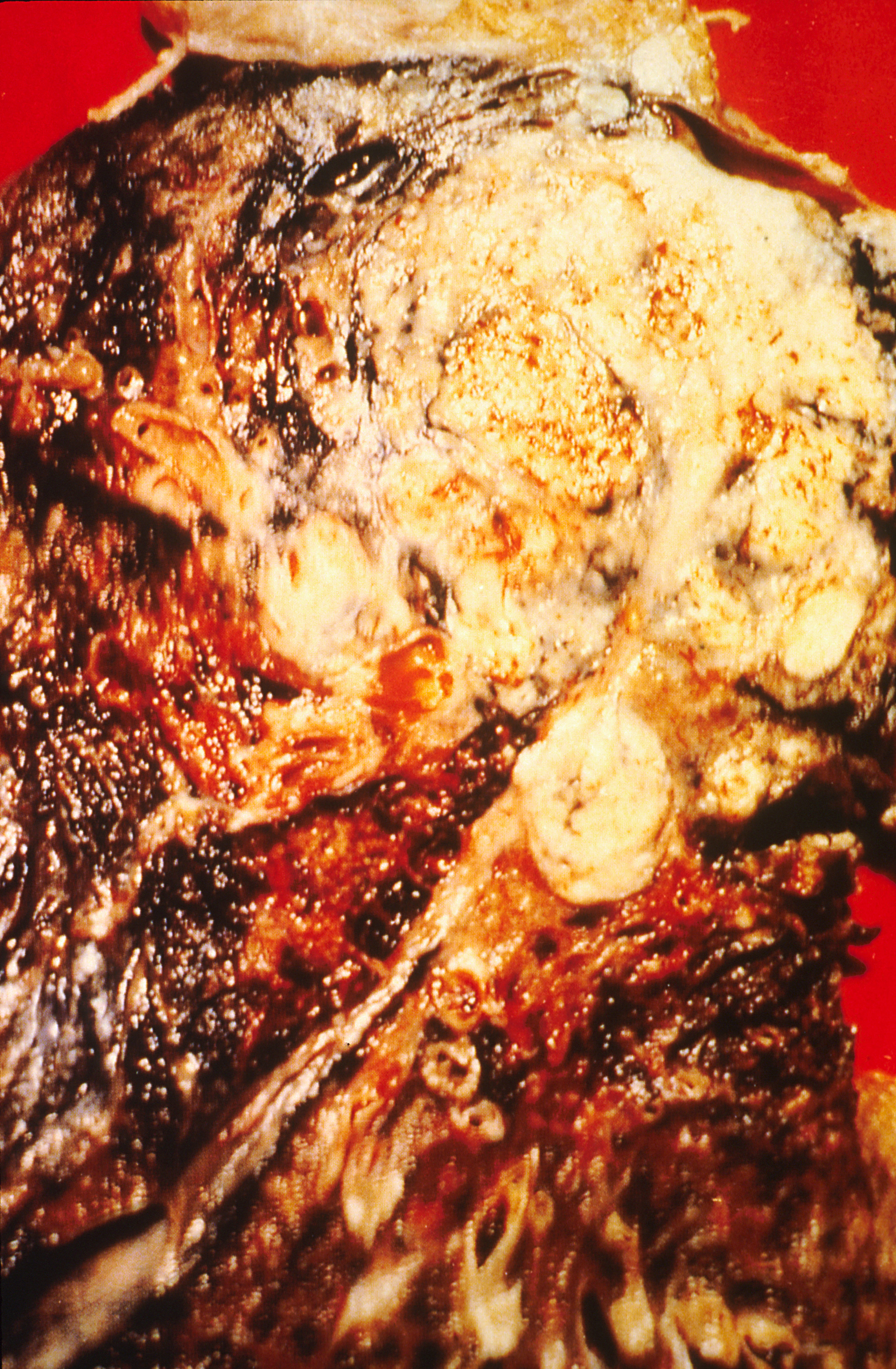 Imagem de referência de cancro do pulmão, descrito nos dados abertos como tumor maligno no pulmão