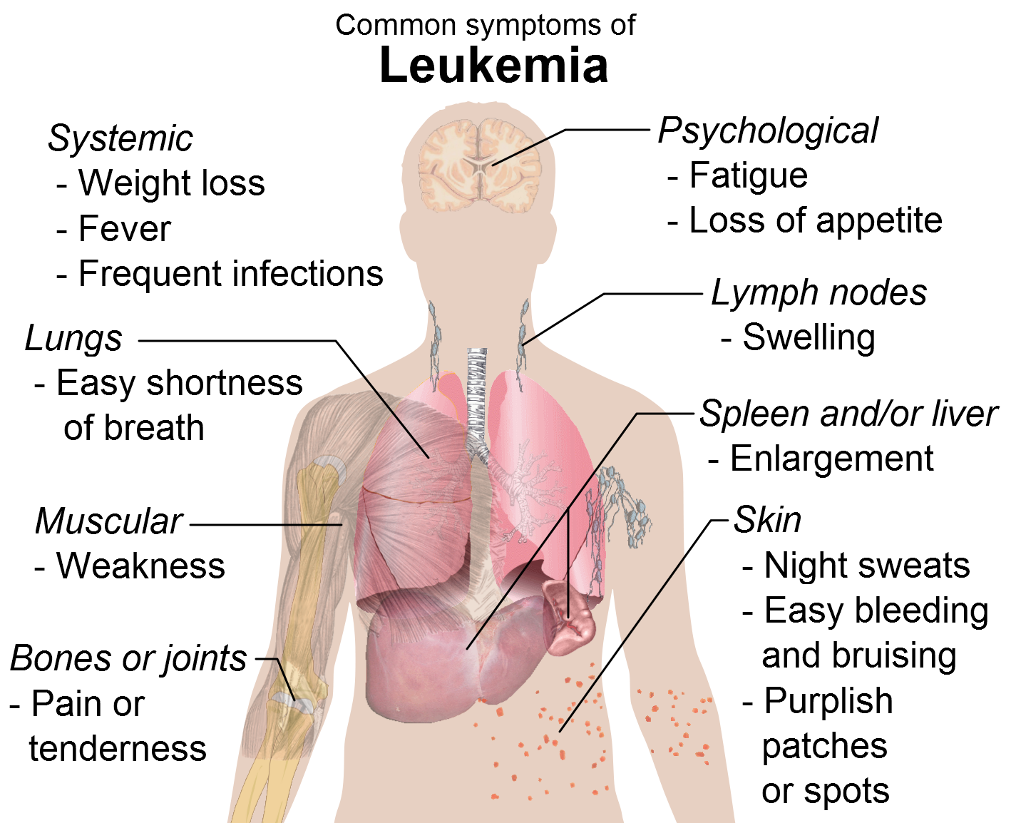 Imagem de referência de leucemia, descrito nos dados abertos como vários tipos de cânceres sanguíneos que se originam na medula óssea