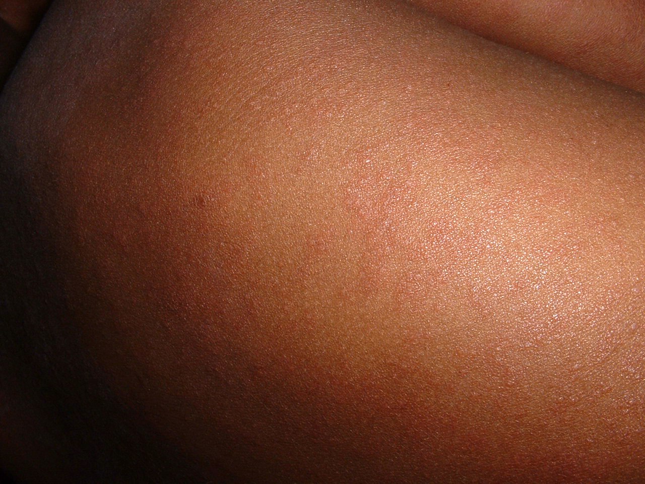 Imagem de referência de sarampo, descrito nos dados abertos como doença altamente contagiosa causada pelo vírus do sarampo