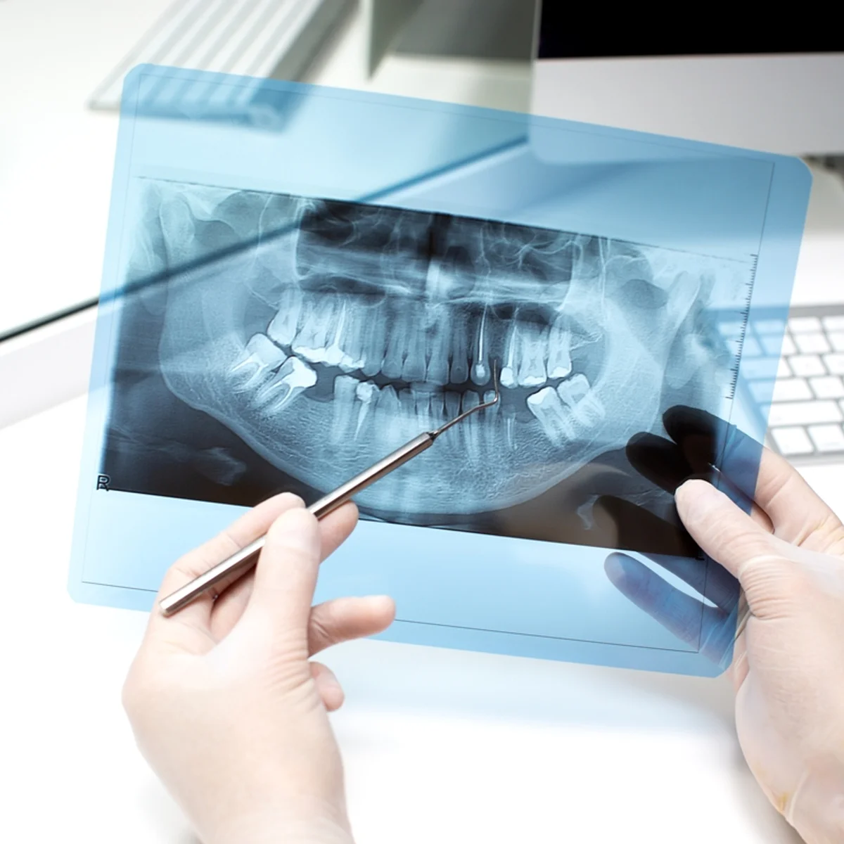 Estudo encontra 19 substâncias químicas nos dentes de crianças com autismo