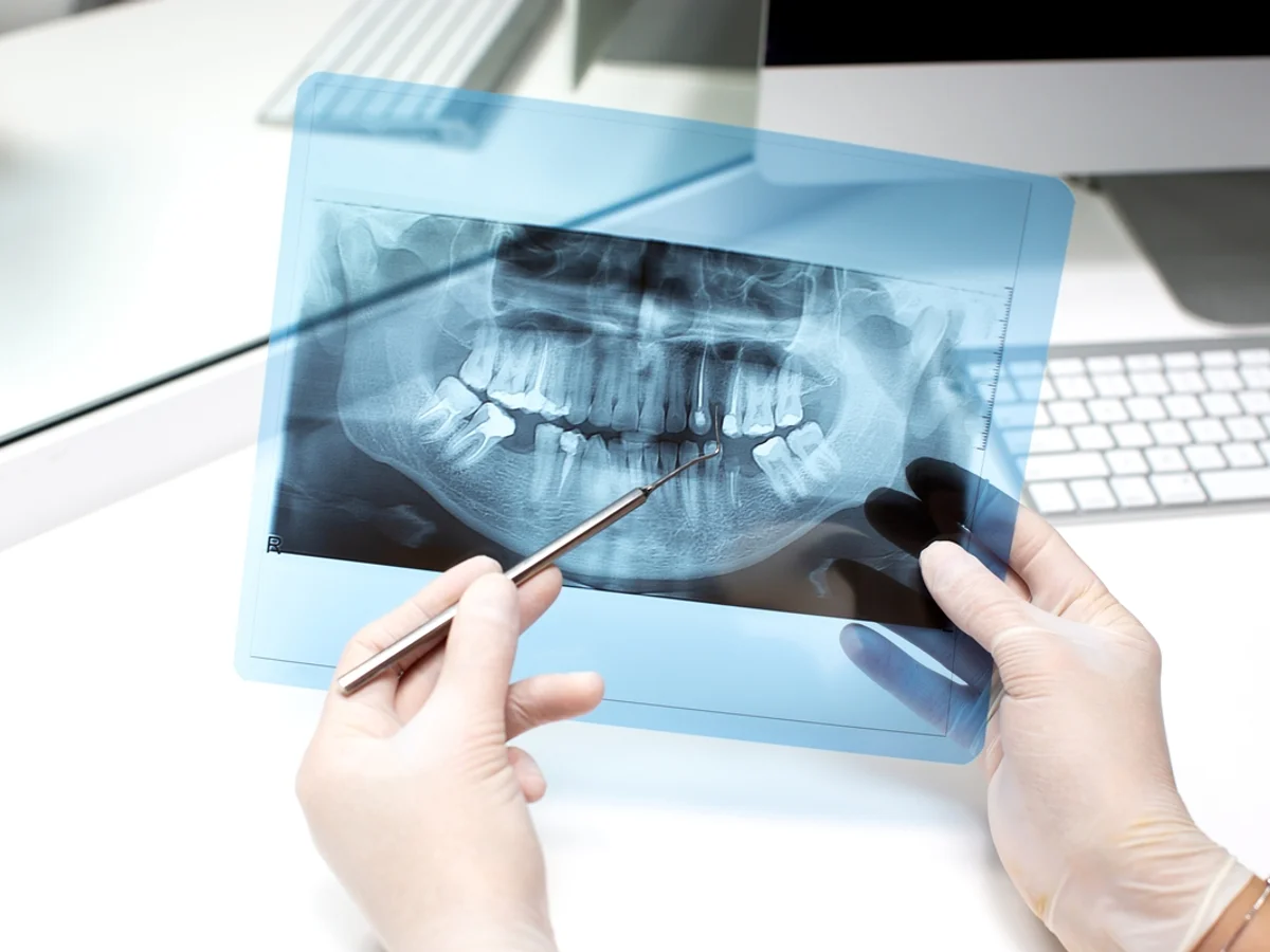 Estudo encontra 19 substâncias químicas nos dentes de crianças com autismo